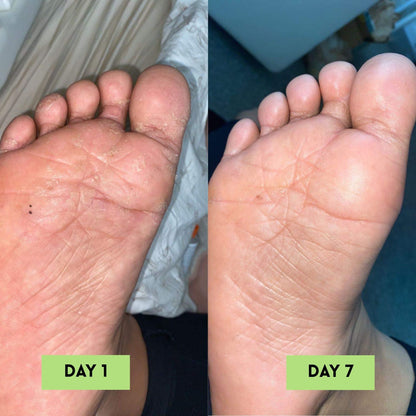 Tea Tree Oil AntiFungal Soap